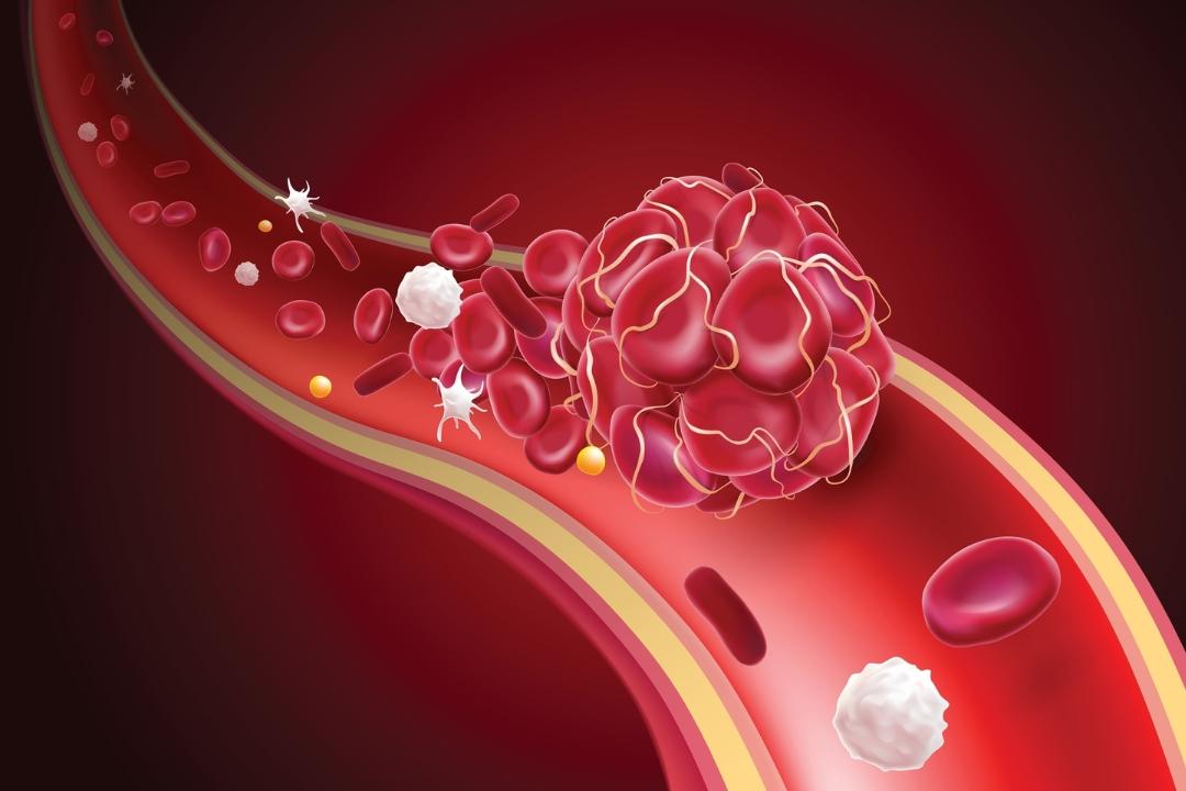 Blood clot within blood vessel